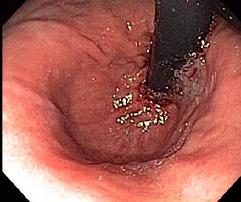 Hiatal Hernia Retroverted View