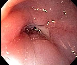 Esophageal Sticture with Ulceration
