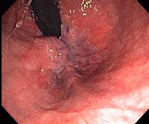 Hemorrhoids