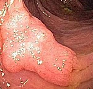 Nonpolypoid superficial elevated adenoma
