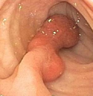 Pedunculated tubulovillous adenoma with high grade dysplasia