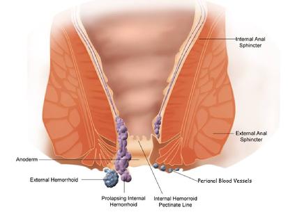 Hemorrhoids